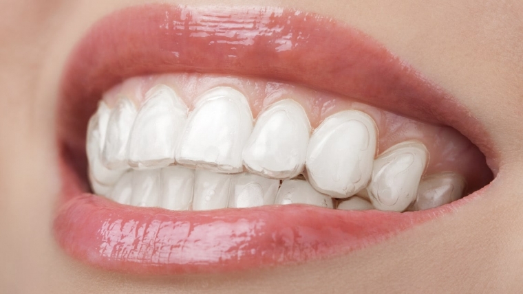 Zahnkorrektur mit durchsichtigen Zahnschienen